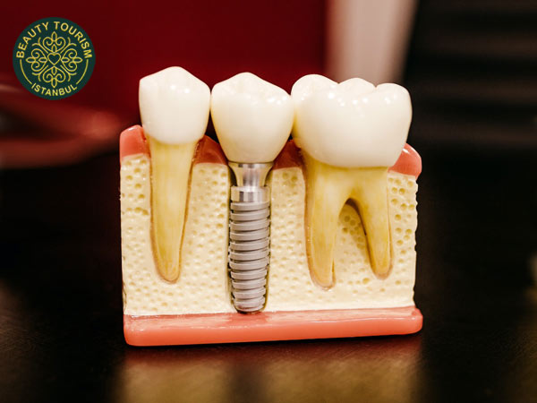 Встановлення імплантів