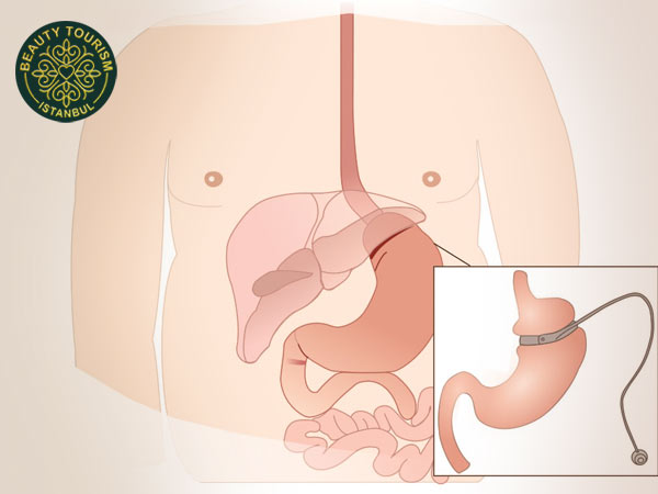 Встановлення імплантів